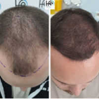 patient-X-10months patient-X-10months