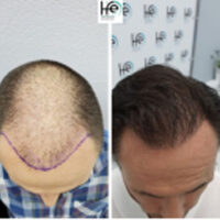 patient-X-12months patient-X-12months