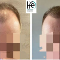 patient-X-8months patient-X-8months